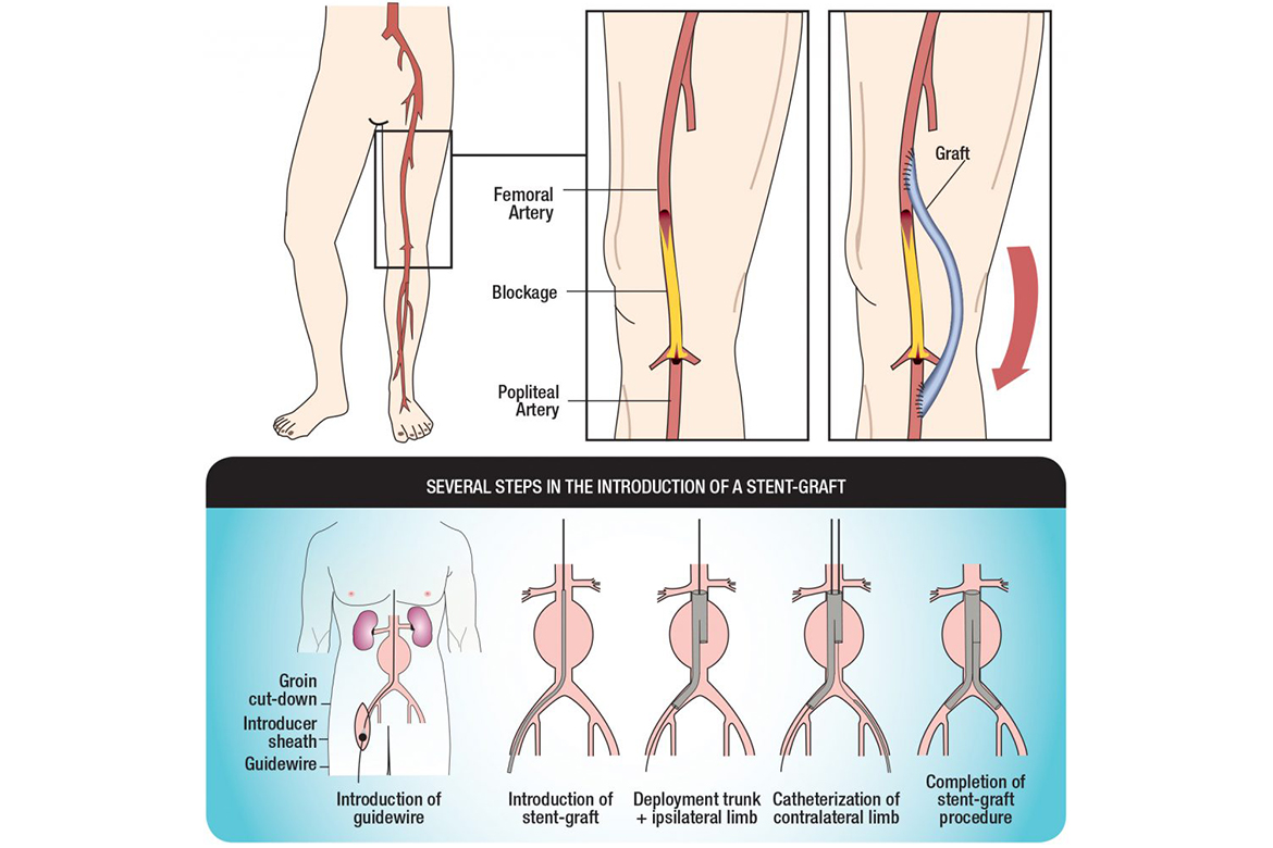 Arterial-Aneurysms-the-need-for-vigilance-image