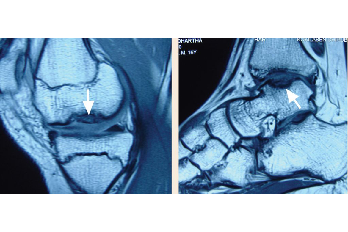 Autologous-chondrocyte-implantation-for-Multifocal-osteochondritis-dissecans-images