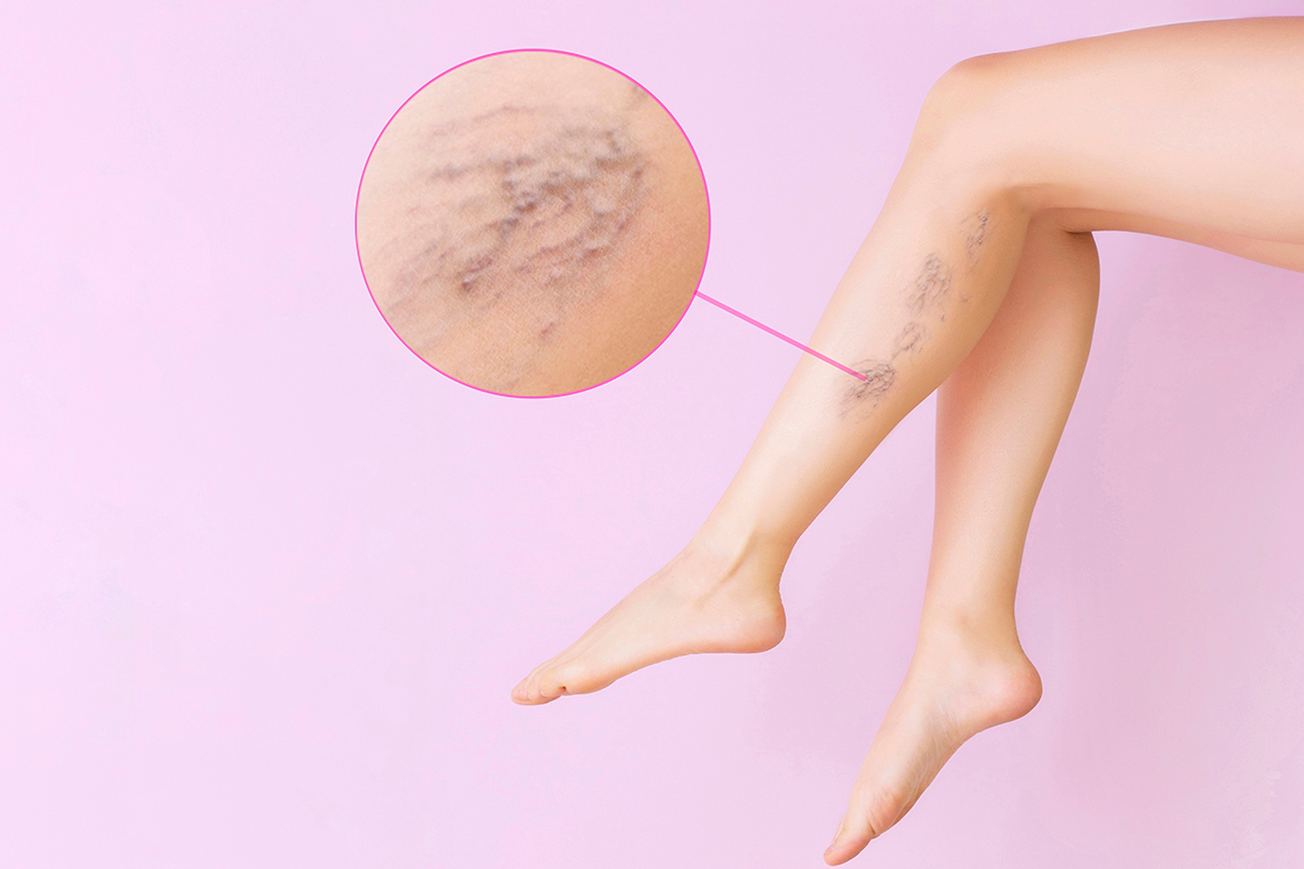 Varicose-Veins-Clinic-image