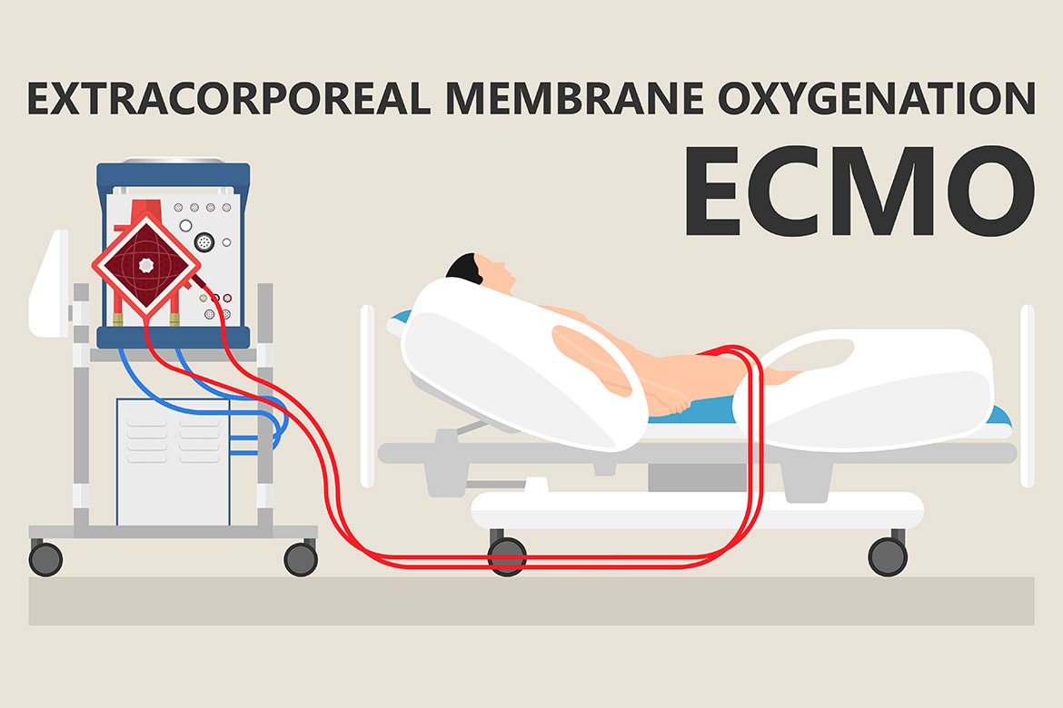 ecmo-image